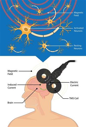 Transcranial Magnetic Stimulation diagram