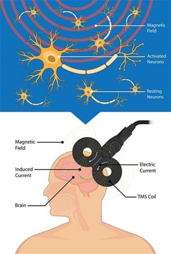 Transcranial Magnetic Stimulation diagram Transcranial Magnetic Stimulation diagram